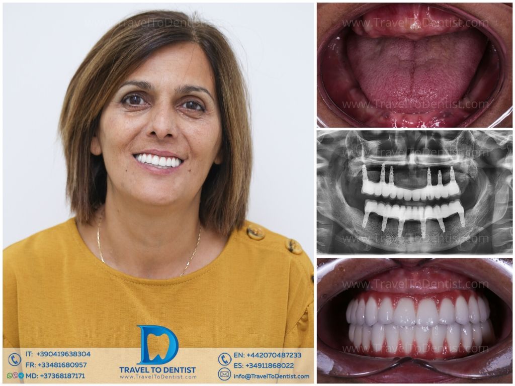 Caso clínico 5 — Transformación dental