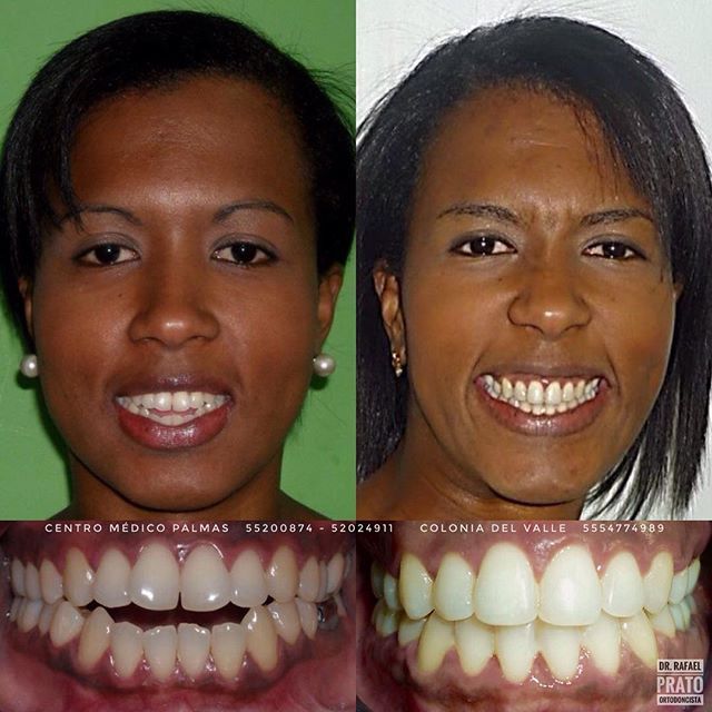 Caso clínico 6 — Transformación dental