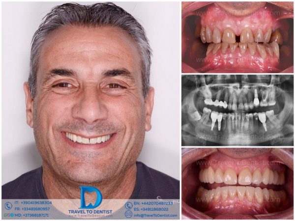 Caso clínico 2 — Transformación dental